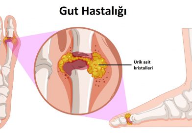 Gut Hastalığı Nedir?